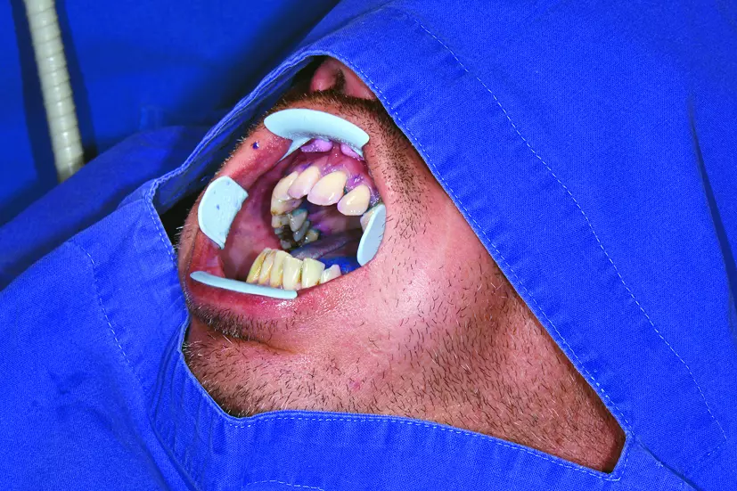 Abb. 4: Schutz des Patienten mit einem Tuch. Alternativ ist das Tragen einer Schutzbrille möglich.