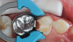 Abb. 4: Anlegen des Teilmatrizensystems Palodent® V3.