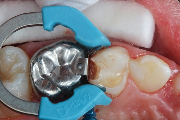 Abb. 4: Anlegen des Teilmatrizensystems Palodent® V3.