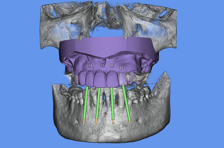 Abb. 4: Wax-up für die digitale Implantatplanung.