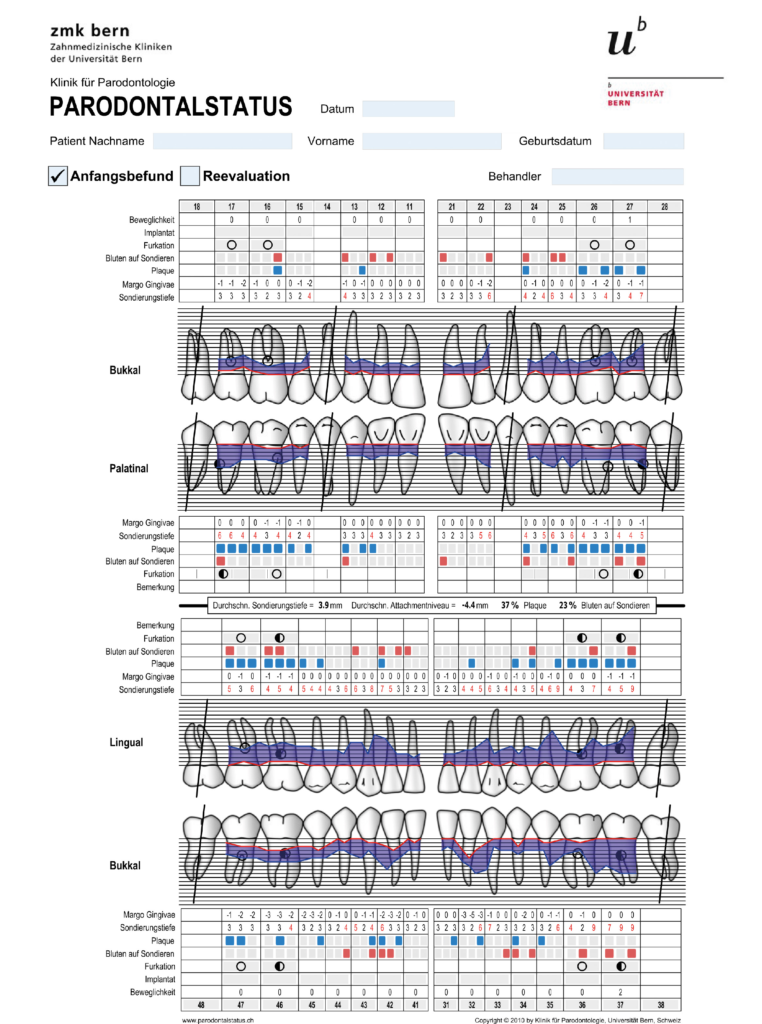 Abb. 4: Der parodontale Ausgangsbefund zeigte das gesamte Spektrum diagnostischer klinischer Parameter.
Es lagen Sondierungstiefen bis 9 mm, Bluten auf Sondieren, Furkationsbeteiligungen und erhöhte
Lockerungsgrade vor.
