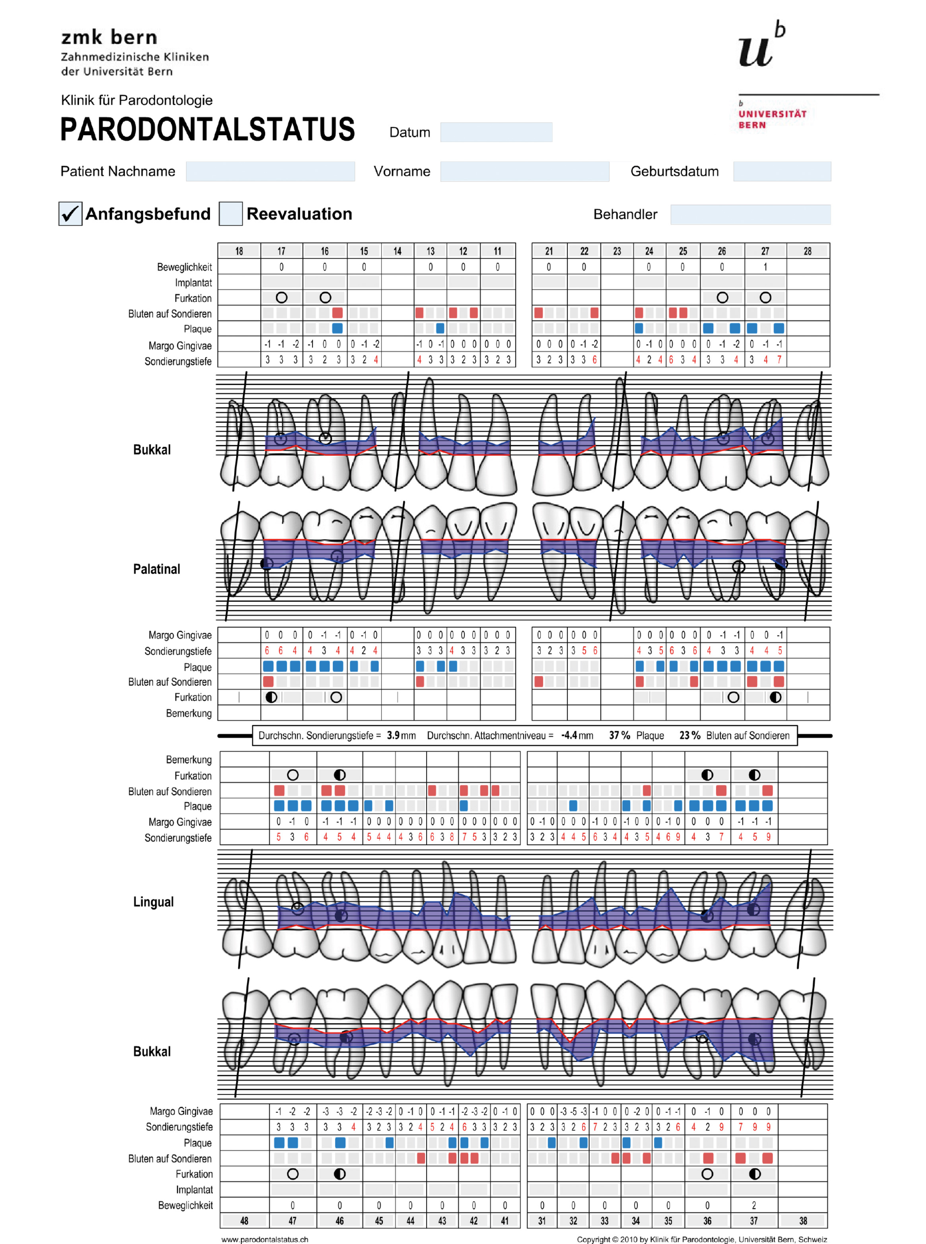 Abb. 4: Der parodontale Ausgangsbefund zeigte das gesamte Spektrum diagnostischer klinischer Parameter.
Es lagen Sondierungstiefen bis 9 mm, Bluten auf Sondieren, Furkationsbeteiligungen und erhöhte
Lockerungsgrade vor.