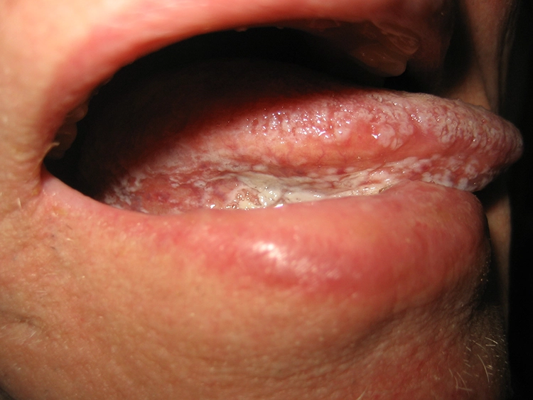 Abb. 4: Orale Haarleukoplakie: nicht abstreifbare verruköse Veränderung vorwiegend am seitlichen Zungenrand. Nahezu pathognomonisch für einen HIV-bedingten Immundefekt.