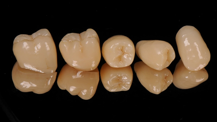 Abb. 5: Restaurationen aus VarseoSmile Crownplus nach der Politur. Zusätzlich können diese auch mittels handelsüblicher Kompositmalfarben individualisiert werden.