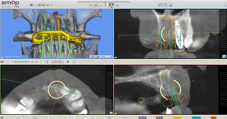Abb. 5: Planung der Implantatposition und Guided Surgery Schablone.