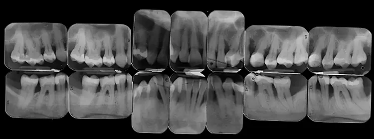 Abb. 5: Der radiologische Befund zeigte horizontalen und an einigen Zähnen auch vertikalen Knochenverlust sowie Radioluzenzen im Furkationsbereich.