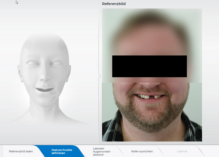 Abb. 5: Die Ausdehnung der Mundöffnung wurde für die Software mit Punkten markiert.