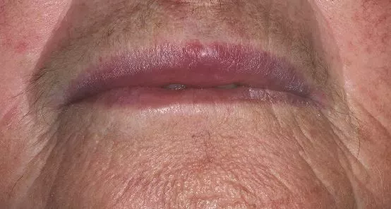Abb. 6: Patientenfall Allergie nach Einnahme von Penicillin.