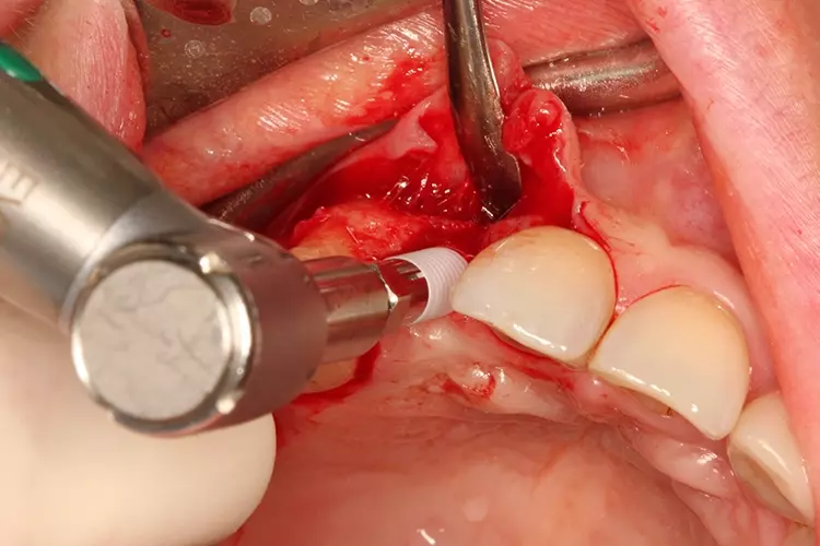 Abb. 6: Einbringen des Implantats.