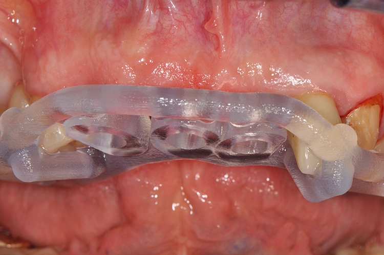 Abb. 6: Einprobe der Guided Surgery Schablone.
