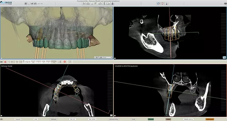 Abb. 7: Digitale, präoperative Planung in der 3D-Software SMOP, individuell an die Patientensituation angepasst.