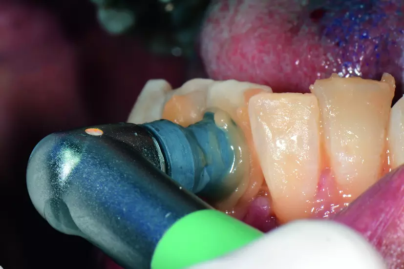 Abb. 7: Politur mit Clinpro Prophy Paste.