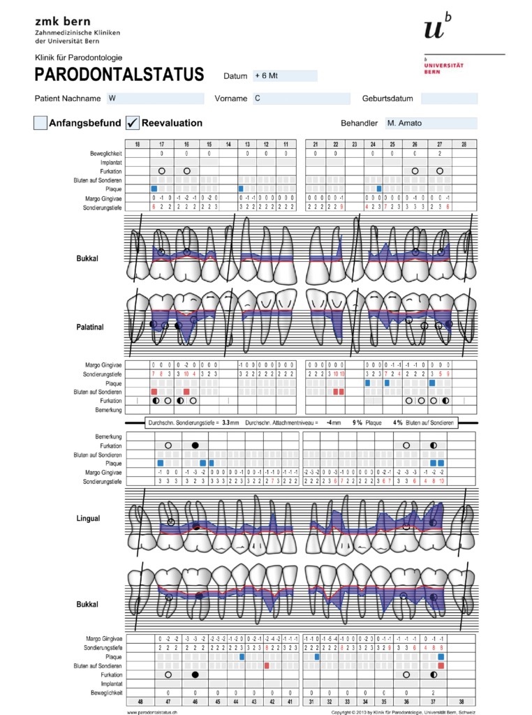 Abb. 7: Die Befundevaluation mit einem Parodontalstatus 6 Monate nach nichtchirurgischer Therapie zeigte
Verbesserungen. Allerdings lagen noch einige erhöhte Sondierungstiefen ≥ 6 mm vor. Basierend auf diesem
Befund erfolgte die weitere Therapieplanung. Nun waren parodontalchirurgische Eingriffe indiziert.