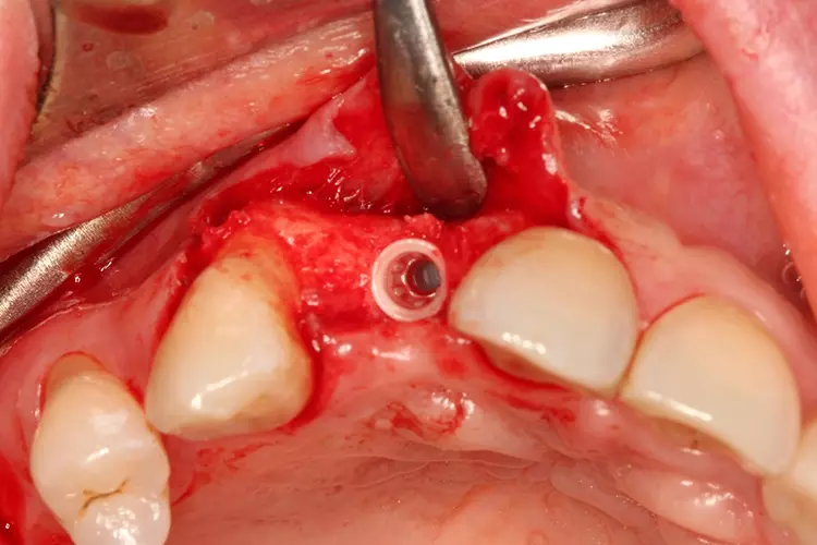 Abb. 8: Das Implantat wurde auf Knochenniveau gesetzt.