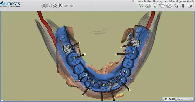 Abb. 8: Digitale, präoperative Planung in der 3D-Software SMOP, individuell an
die Patientensituation angepasst.