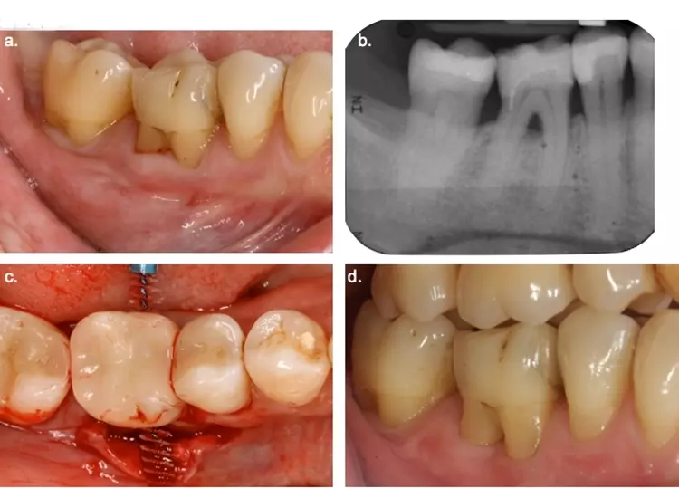 Abb. 8: Klinische (a) und radiologische (b) Situation im 4. Quadranten. Zahn
46 war der Mundhygiene mit Interdentalraumbürstchen nicht zugängig. Um
Mundhygienefähigkeit zu etablieren, erfolgte eine chirurgische Tunnelpräparation.
Zur Degranulierung und Evaluation der Passung wurden bereits intraoperativ
entsprechende Mundhygienehilfsmittel eingesetzt (c). Nach Abschluss der Wundheilung
war der Furkationsbereich gut sichtbar und zugängig. Die Patientin war
instruiert, täglich alternierend mit Fluorid- bzw. Chlorhexidingel zu applizieren.