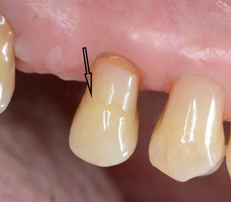 Abb. 8a: Restaurative Therapie eines Zahnhalsdefektes
bei einem 80-jährigen Patienten aus ästhetischen und funktionellen Gründen: vestibulär an der vorhandenen Restauration neuer erosiver Defekt aufgetreten (siehe Pfeil). (Ausganssituation).
