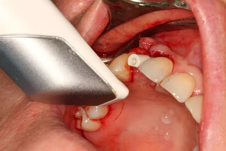 Abb. 9: Registrierung der Implantatposition mit einem Intraoralscanner zur Herstellung
des Langzeitprovisoriums.