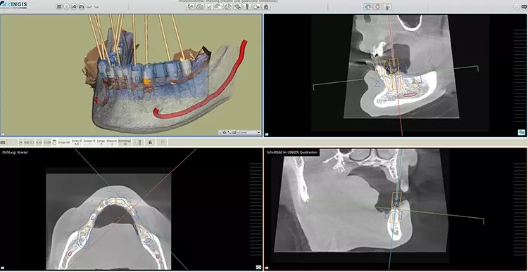 Abb. 9: Digitale, präoperative Planung in der 3D-Software SMOP, individuell an
die Patientensituation angepasst.