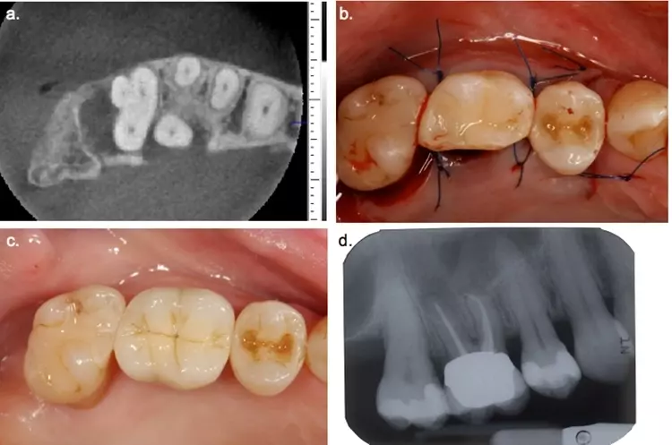 Abb. 9: a) Axiale DVT-Aufnahme der Zähne 17, 16 und 15 – aufgrund des fortgeschrittenen
Attachmentverlusts an der palatinalen Wurzel von Zahn 16 wurde die
Entfernung der palatinalen Wurzel und bei Erhalt der bukkalen Wurzeln geplant, an
Zahn 17 sollte eine distale Keilexzision durchgeführt werden; b) Situation postoperativ
nach Entfernung der palatinalen Wurzel, die bukkoorale Ausdehnung wurde zur
Vermeidung etwaiger Hebelwirkungen auf die bukkalen Wurzeln reduziert; c) klinische
Situation und (d) radiologische Kontrolle nach Insertion der Krone an Zahn 16.