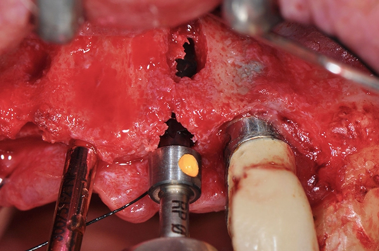 Abb. 9: Aufbereitung des Implantatbetts mit Profilbohrer.