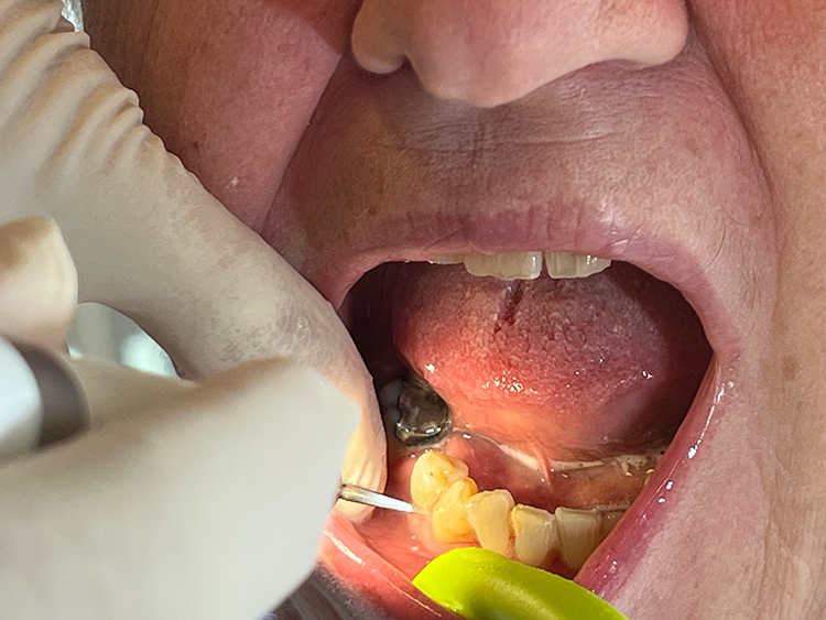 Abb. 9a: Antiinfektiöse Therapie in der aufsuchenden Betreung mit Handinstrumenten.