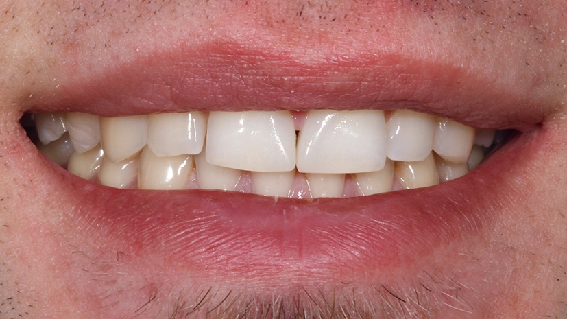 Abb. 22: Das neue, nun deutlich harmonischere Lippenbild des Patienten.