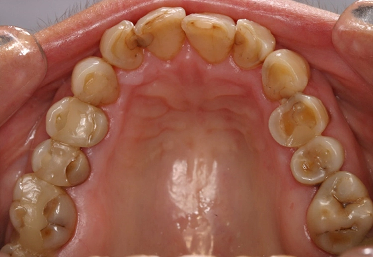 Abb. 2b: Patientin mit einem Sjögren-Syndrom. Deutlich zu erkennen sind die trockenen, glänzenden Schleimhäute sowie die Erosionsdefekte, deren Entstehung durch die fehlende Speichelprotektion begünstigt wurde.