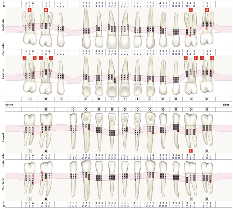 Abb. 4: Parodontalstatus (PA-Konzepte Voice GmbH, Sendenhorst, Deutschland) bei erneuter Reevaluation aller Parameter nach 1-jähriger UPT (September 2020).