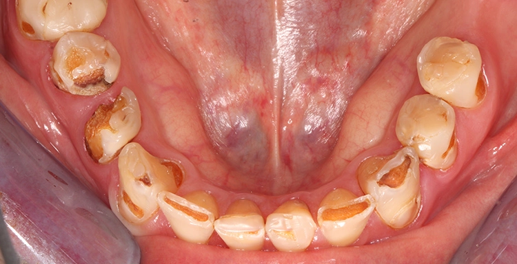 Abb. 4: Patient nach einer Stammzelltransplantation. Die Therapeutika zur Immunsuppression verändern nachhaltig die oralen Bedingungen, sodass es hier zu einer stark progressiven Form der Karies gekommen ist.