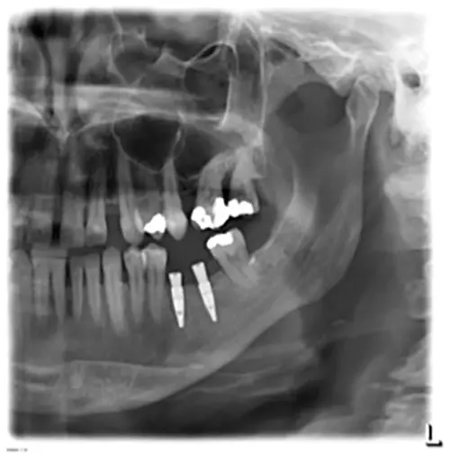 Abb. 11: Postoperative Panoramaschichtaufnahme nach der Augmentation.