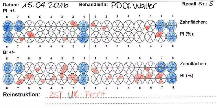Abb. 11: 9 Monate nach subgingivaler Instrumentierung und knapp 13 Monate nach Therapiebeginn bestand eine gute Mundhygiene mit einem PI 7,6% und einem BI 20,8% (Abb. 11). Es lagen nahezu überall geschlossene parodontale Taschen bzw. Sondierungstiefen < 5 mm vor (Abb. 12). Es erfolgten wiederum eine bedarfsgerechte supra- und subgingivale Instrumentierung sowie eine Mundhygieneinstruktion.
