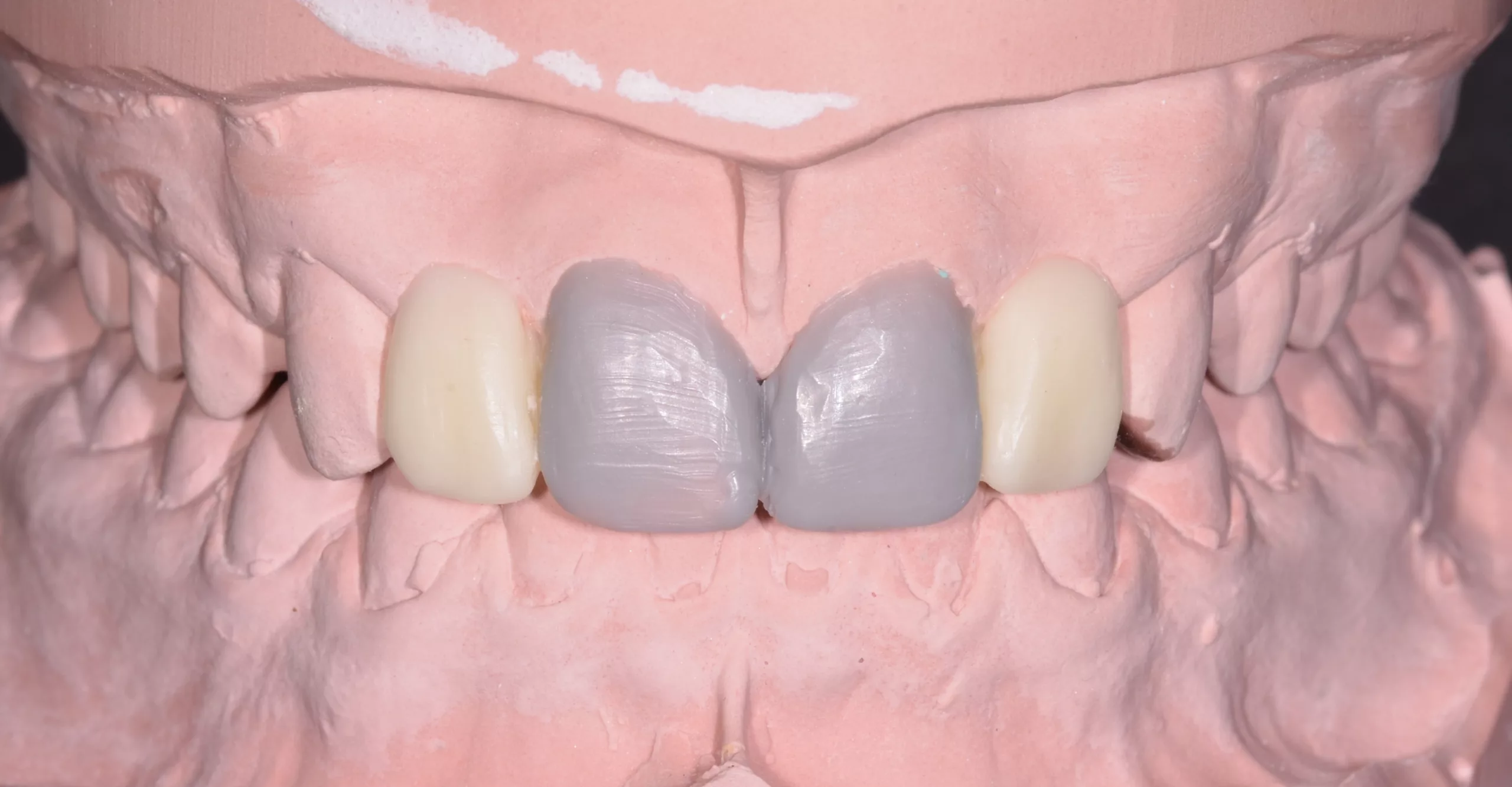 Abb. 3: Umsetzung eines konventionell hergestellten Wax-ups in ein Mock-up im
Patientenmund. a: Konventionell auf dem Gipsmodell aufgewachste Frontzähne.