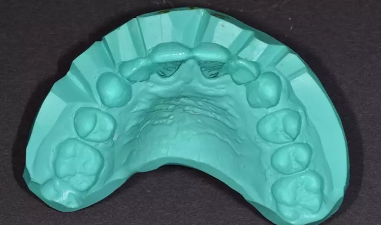 Abb. 3: Umsetzung eines konventionell hergestellten Wax-ups in ein Mock-up im
Patientenmund. b: Silikonform zur Überführung des Wax-ups in den Patientenmund. Das Silikon
sollte nicht zu weich sein. Eine Shore-Härte von ca. 80–85 ist empfehlenswert.
Die Oberfläche sollte außerdem detailgetreu wiedergegeben werden, damit ein
ästhetisch anspruchsvolles Ergebnis entsteht und intraoral möglichst wenig nachgearbeitet
werden muss.