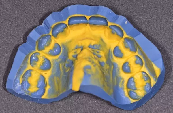 Abb. 3: Umsetzung eines konventionell hergestellten Wax-ups in ein Mock-up im
Patientenmund. b: Silikonform zur Überführung des Wax-ups in den Patientenmund. Das Silikon
sollte nicht zu weich sein. Eine Shore-Härte von ca. 80–85 ist empfehlenswert.
Die Oberfläche sollte außerdem detailgetreu wiedergegeben werden, damit ein
ästhetisch anspruchsvolles Ergebnis entsteht und intraoral möglichst wenig nachgearbeitet
werden muss.