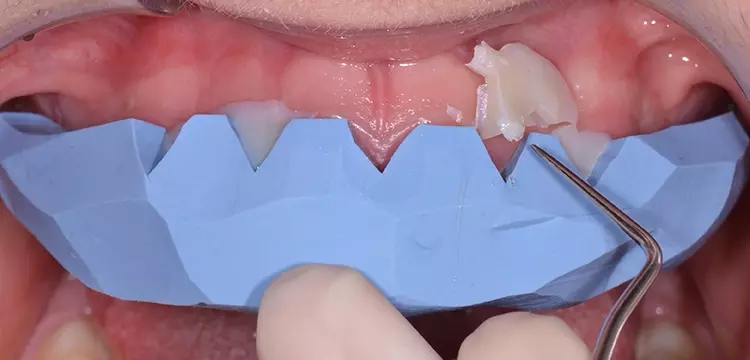 Abb. 3: Umsetzung eines konventionell hergestellten Wax-ups in ein Mock-up im
Patientenmund. c: Herstellung eines Mock-ups: Ein Provisorienkunststoff wird in die Silikonform
eingebracht, ohne vorab die Zähne zu isolieren. Nach Aushärten können die
Kunststoffüberschüsse durch Beschneiden der Silikonform entlang des Gingivasaumes
leicht entfernt werden und die Silikonform kann abgenommen werden.