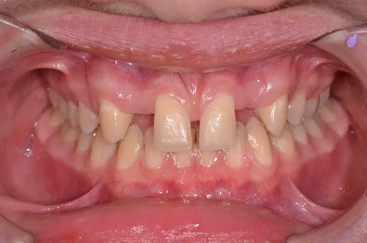 Abb. 3: Umsetzung eines konventionell hergestellten Wax-ups in ein Mock-up im
Patientenmund. d: Mock-up nach Abnahme der Silikonform: Durch die hohe Oberflächengenauigkeit des verwendeten Silikons muss nur wenig aus- oder nachgearbeitet werden, um
ein detailgenaues und ästhetisches Ergebnis zu erzielen.