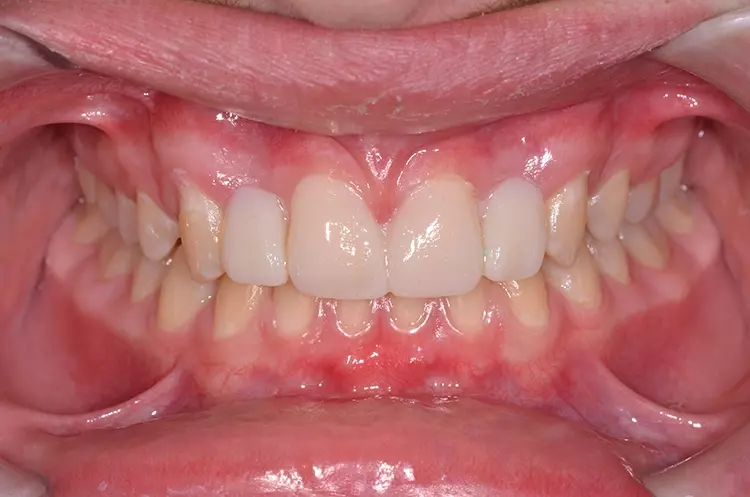 Abb. 3: Umsetzung eines konventionell hergestellten Wax-ups in ein Mock-up im
Patientenmund. d: Mock-up nach Abnahme der Silikonform: Durch die hohe Oberflächengenauigkeit des verwendeten Silikons muss nur wenig aus- oder nachgearbeitet werden, um
ein detailgenaues und ästhetisches Ergebnis zu erzielen.