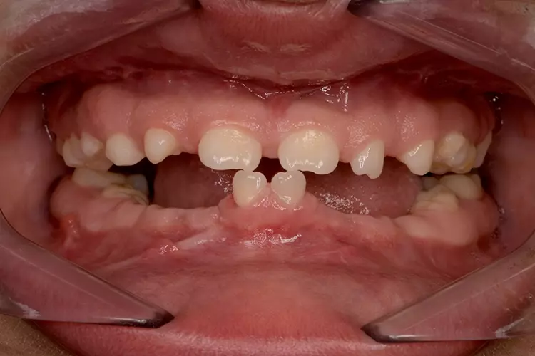 Abb. 4: Wax-up und Mock-up sind in komplexeren Situationen zwingend zur Erstellung des definitiven Therapieplanes notwendig. Hier musste ein Mock-up hergestellt
werden, nicht nur um den Zahnersatz zu planen, sondern auch um die Implantatpositionen vor dem chirurgischen Eingriff festzulegen. a: Ausgangssituation vor Herstellung
des Mock-ups.