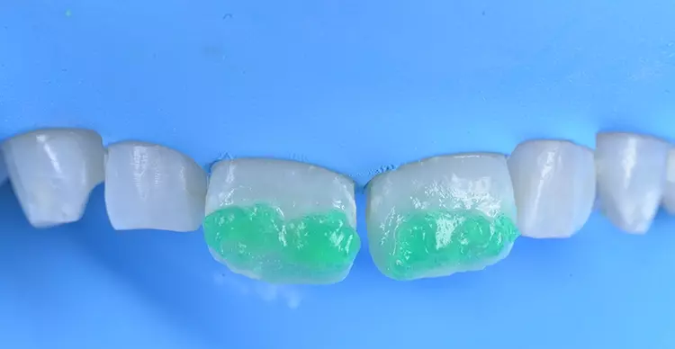 Abb. 11: Kreidig-weiße Oberfläche nach Abschluss der Oberflächenentfernung.