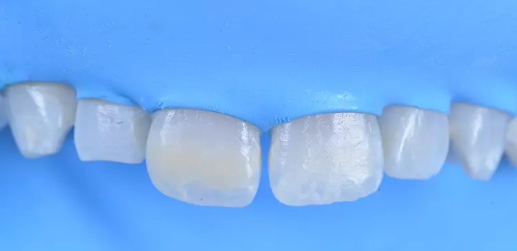 Abb. 12: Klinisches Bild nach Infiltration der Läsionen.