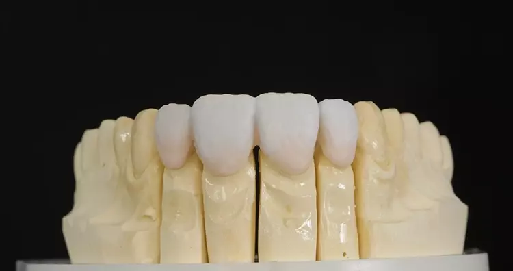 Abb. 8: Digitale Methoden zur Herstellung von definitivem Zahnersatz. d: Danach wird im Hybridverfahren mit MiYO und InSyncZr (Jensen Dental) verblendet.