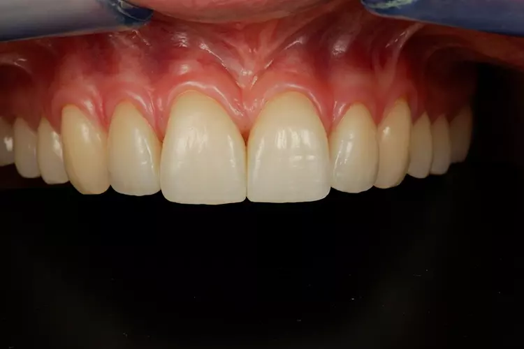 Abb. 8: Digitale Methoden zur Herstellung von definitivem Zahnersatz. e: Die
Lithiumdisilikat-Restaurationen werden schließlich nach Herstellerangaben adhäsiv eingesetzt (emax press, Variolink
esthetik, Ivoclar).