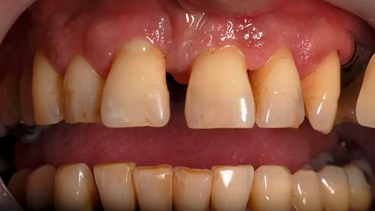 Abb. 1: Klinische Ausgangssituation zum Zeitpunkt der Erstuntersuchung. Austritt von Pus aus dem Sulkus von Zahn 11.