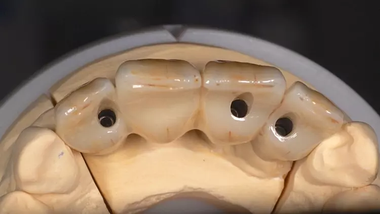 Abb. 10: Oberkiefer-Rekonstruktion nach Fertigstellung im Dentallabor, Ansicht
von okklusal.