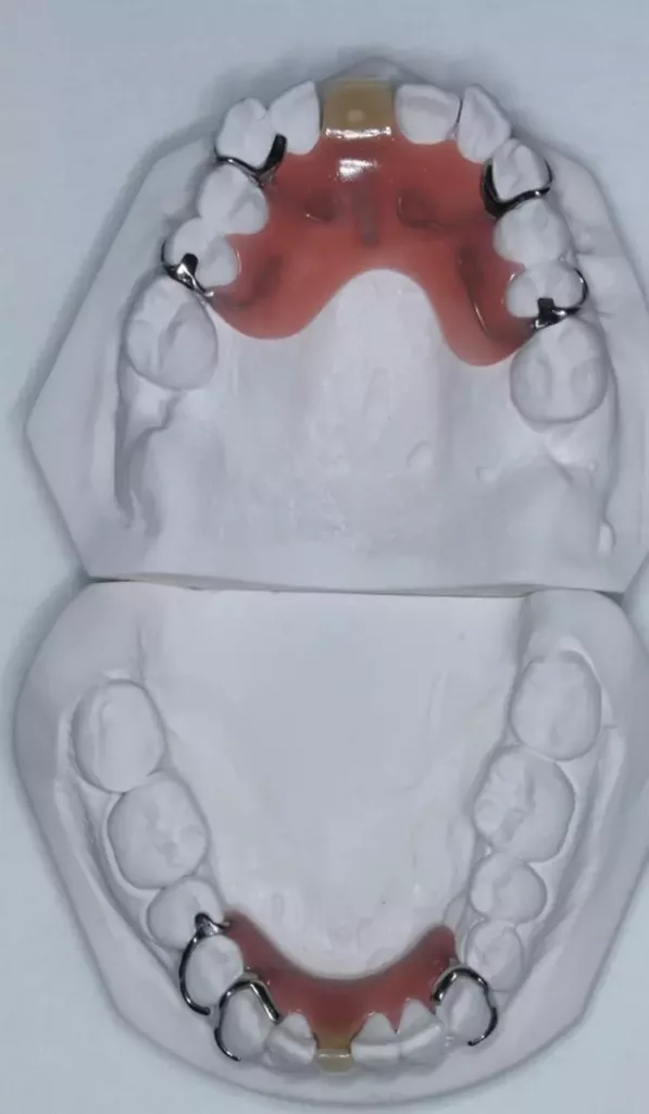 Abb. 10a-d: Im Ober- und Unterkiefer wurde im Rahmen der Stufe-3-Therapie jeweils ein Interimsersatz mit handgebogenen Klammern inseriert. Auf den Ersatz der Zähne 17 und 27 konnte in Absprache mit der Patientin verzichtet werden.