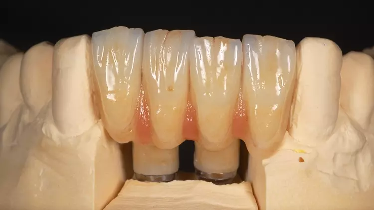 Abb. 11: Unterkiefer-Rekonstruktion nach Fertigstellung im Dentallabor, Ansicht
von vestibulär.