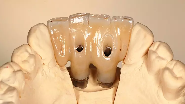 Abb. 12: Unterkiefer-Rekonstruktion nach Fertigstellung im Dentallabor, Ansicht
von okklusal.