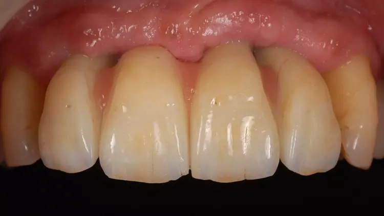 Abb. 13: Klinische Situation nach Einsetzen der Oberkiefer-Rekonstruktion.