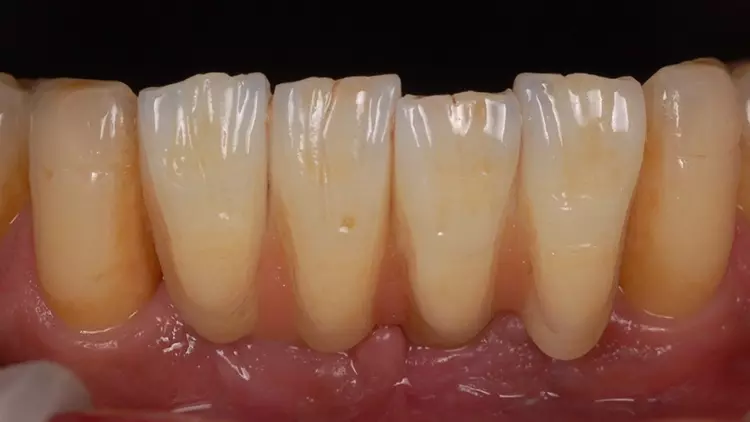 Abb. 14: Klinische Situation nach Einsetzen der Unterkiefer-Rekonstruktion.